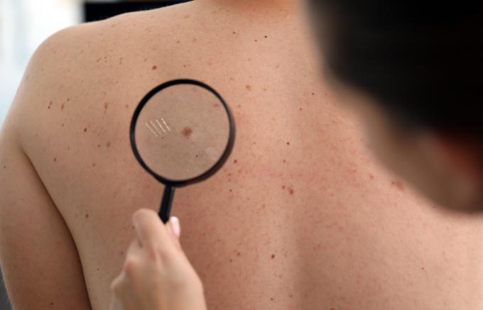 “Hábitos diários definem o risco de câncer de pele”, afirma dermatologista cooperada da Unimed Serra Gaúcha 